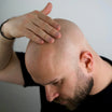 Anti-Pigment Bald Serum (0-6mm)