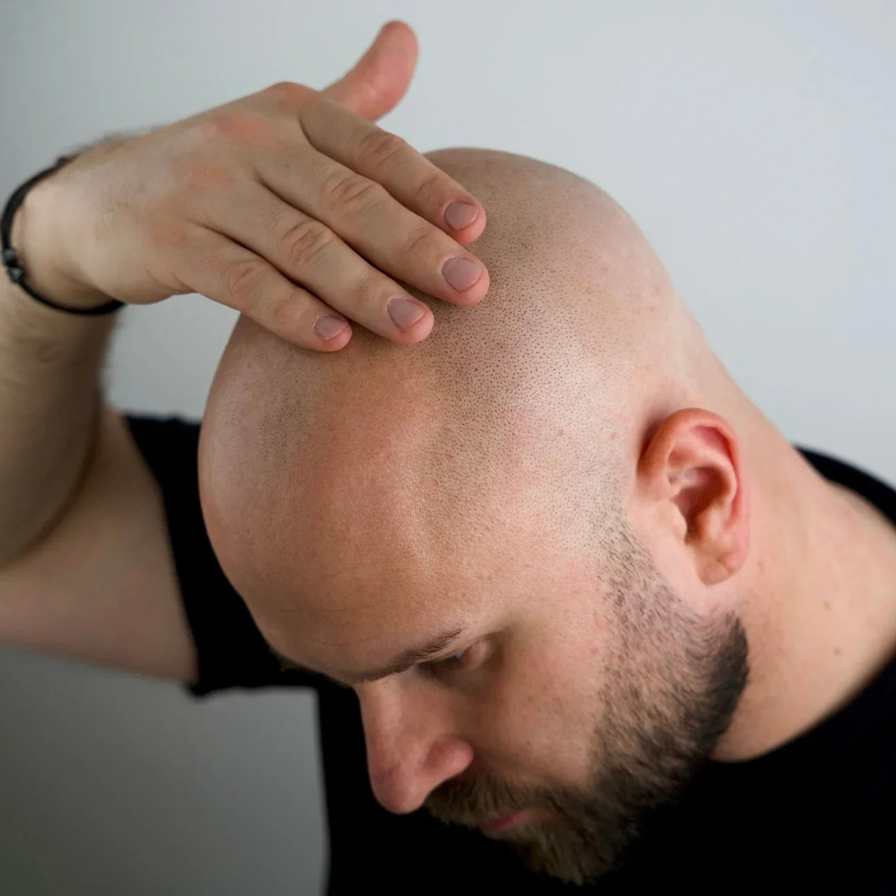 Anti-Pigment Bald Serum (0-6mm)